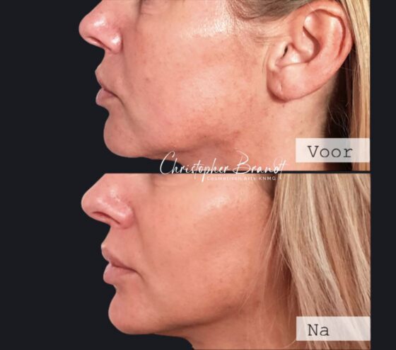 Voor en na resultaat van een Endolift behandeling uitgevoerd door BIG-geregistreerd arts Dr. Brandt.