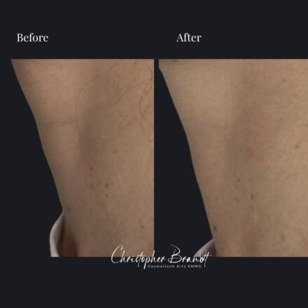 Neck Rejuvenation with Nanofat Stem Cell Treatment and Morpheus8 – Results