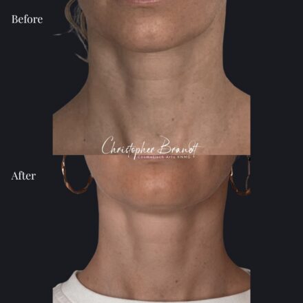 Neck Rejuvenation with Nanofat Stem Cell Treatment and Morpheus8 – Results