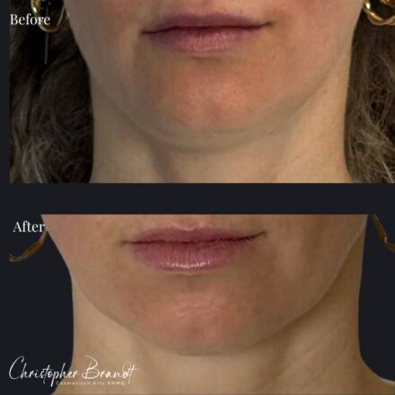 Jawline results after Morpheus8 treatment at Kliniek Dokter Brandt in Amsterdam