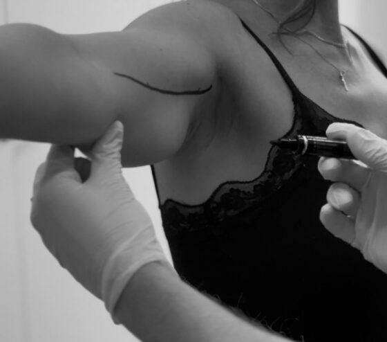 Behandelbeeld van bovenarm liposuctie met QuantumRF bij Kliniek Dokter Brandt, gericht op het verminderen van plaatselijk vet en het verstevigen van de huid.