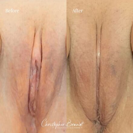 Labia Majora Lipofilling Results – Immediately After Treatment