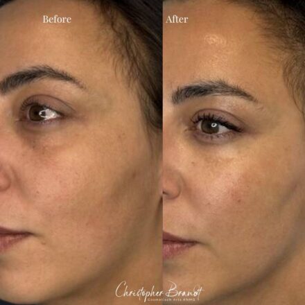 Before and after stem cell facial treatment with microfat and nanofat