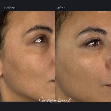 Before and after stem cell facial treatment with microfat and nanofat